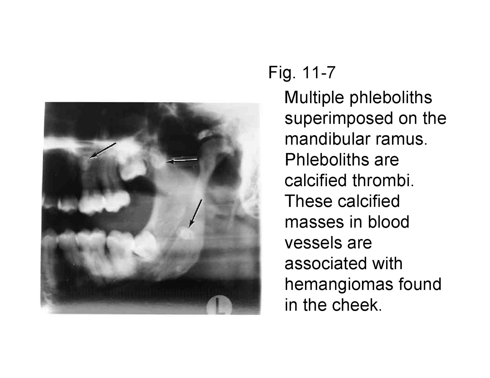 SOFT TISSUE CALCIFICATIONS IN OROMAXILLO FACIAL REGIONwith