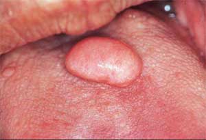 LIPOMA PPT lipoma ppt: