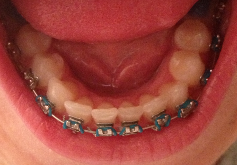 he changes braces lie wow didn would chick orthodontist