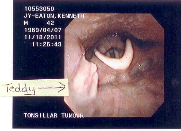 Constant ball of phlegm in back of throat?