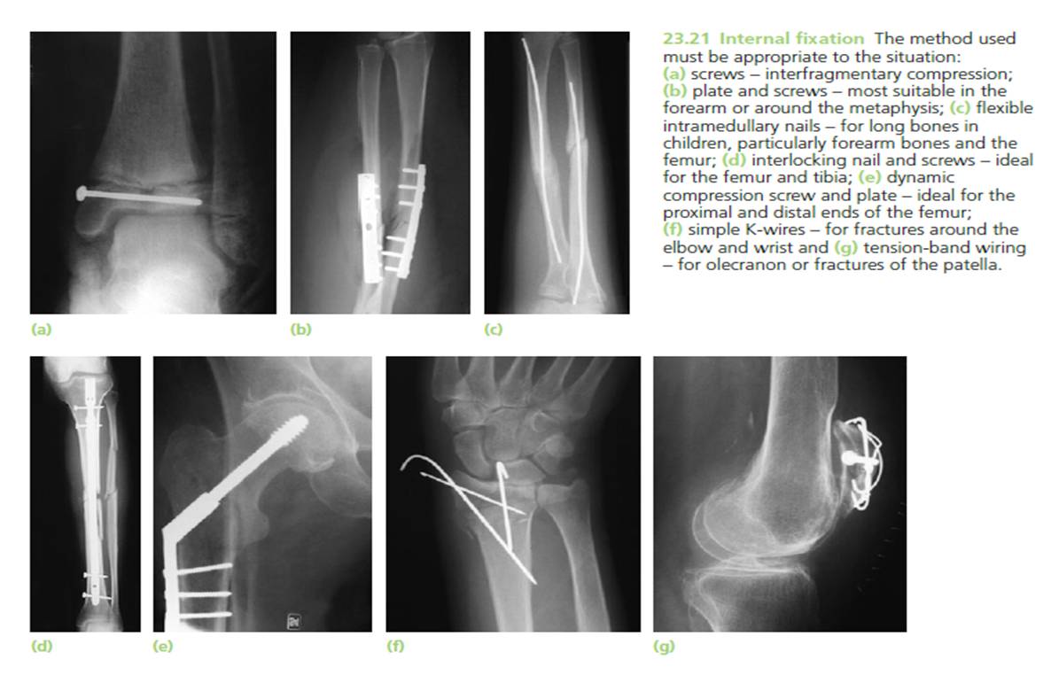 Closed Fracture - My TimeLine