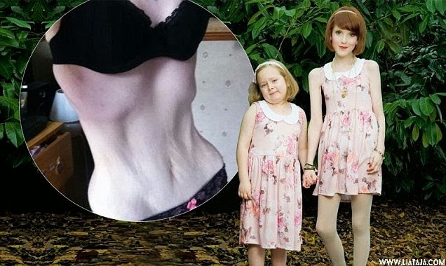 http://www.liataja.com/2014/10/akibat-anoreksia-tubuh-6-orang-ini-jadi-kurus-kering.html