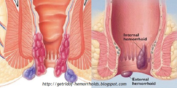 Get symptoms of hemorrhoid flare up