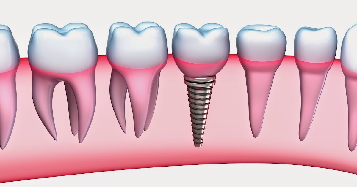 Dentist in Mumbai Dental Implants Cost in Mumbai Tooth Implants