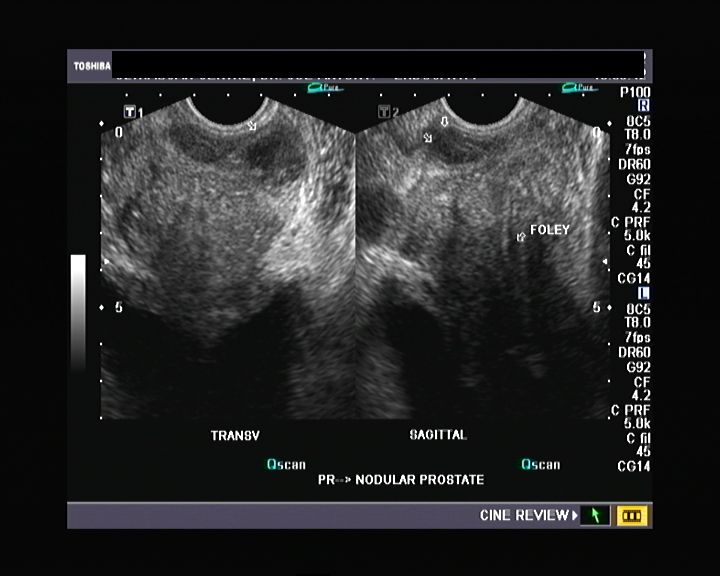 Ultrasound and Color Doppler videos: Prostate -transrectal ultrasound quiz