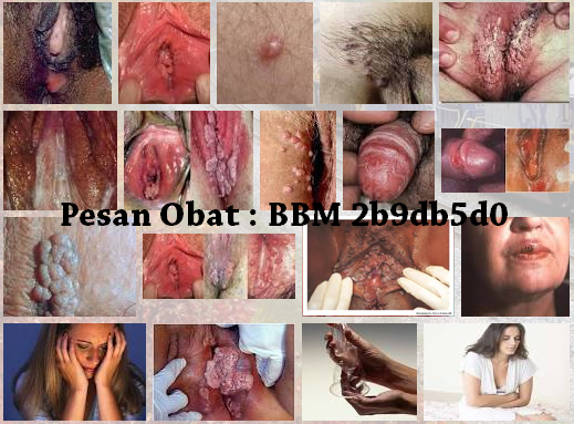 Ada keluhan penyakit tersebut solusinya Silahkan Anda hubungi kontak customer service kami melalui SMS / Telepon / WhatsApp / BBM ke salah satu nomor kami 0852 9090 9793 – 0856 4046 3320 – 0878 3210 6301 (WhatsApp ON) pin 2b9db5d0 Ciri - Ciri Kondiloma Dalam Kehamilan
