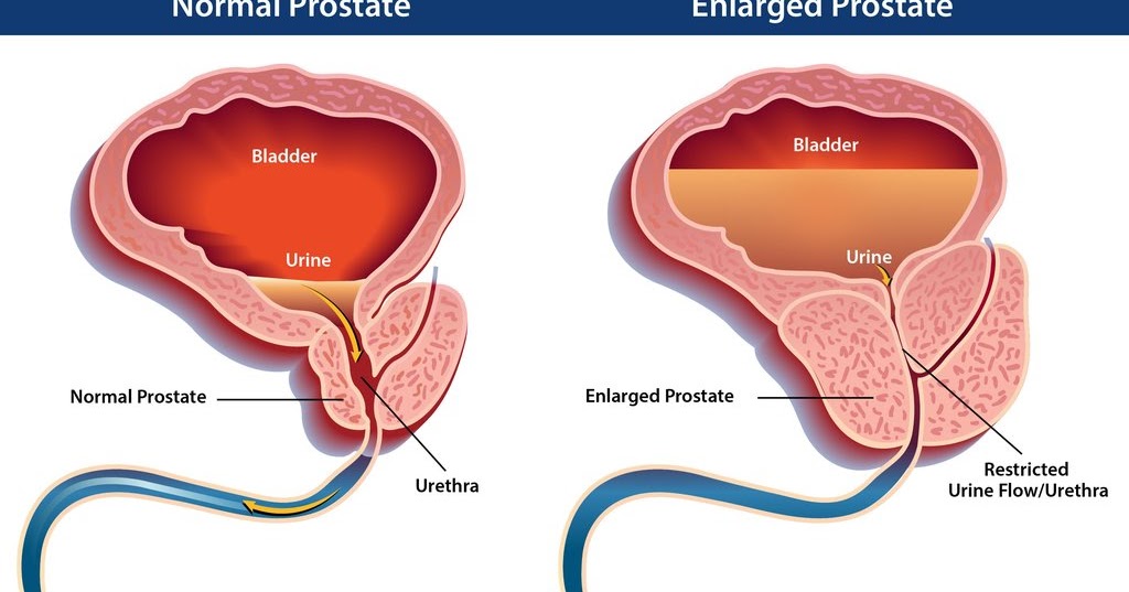 Kinky prostate