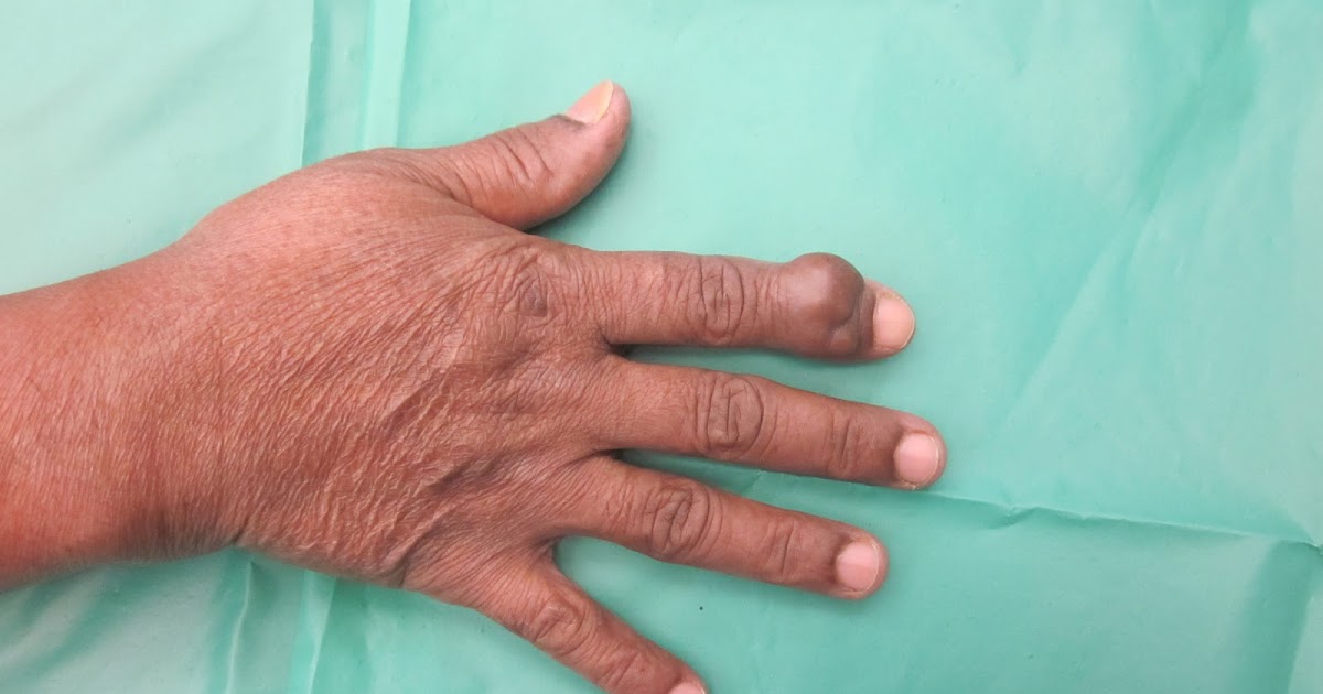 CRUSH INJURIES OF HAND AND UPPER LIMB INJURIES HAND TUMOR GIANT CELL