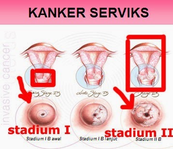 Image Pengobatan terbaik untuk kanker serviks