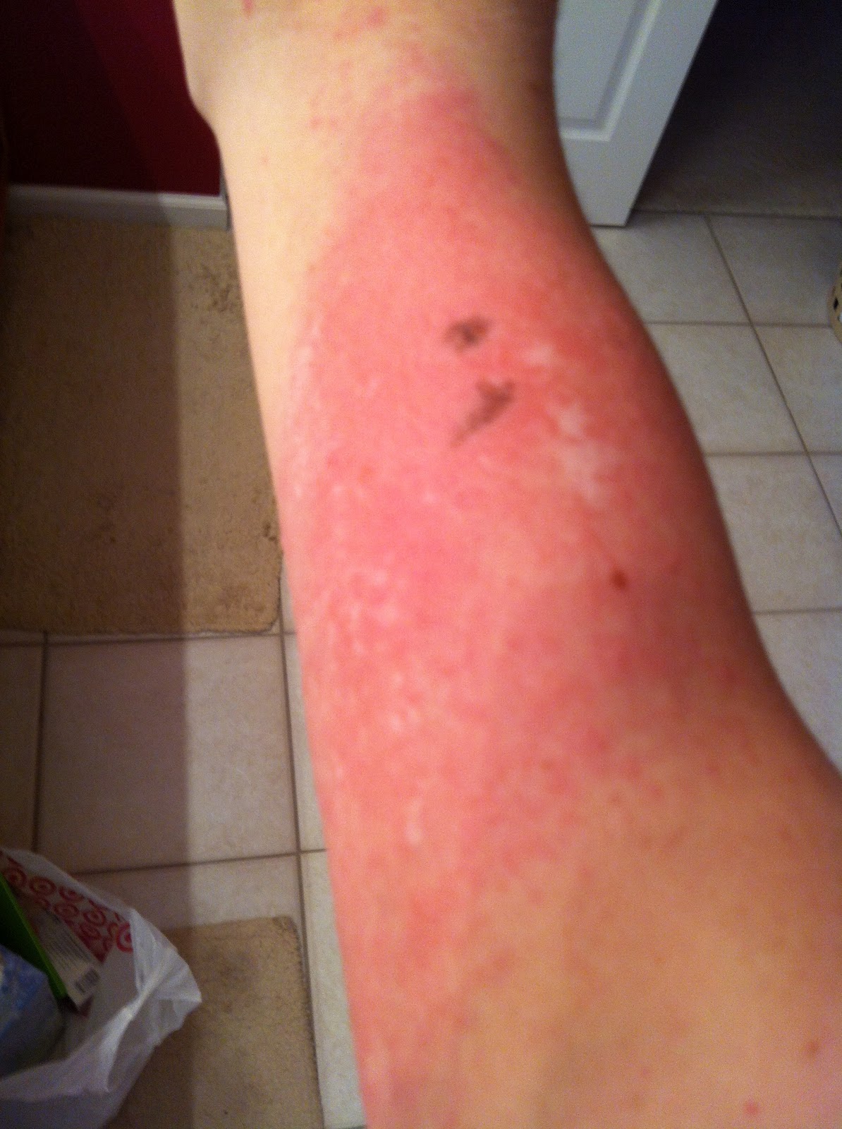 The End of the Poison Ivy Saga. With Pics! Charisa Darling