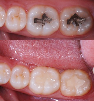 Pratik Bilgiler Dis Dolgusu Cesitleri