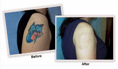 Tattoo Removal Harga | pk oil solusi tepat untuk menghapus dan menghilangkan tato Tattoo Removal Harga | pk oil solusi tepat untuk menghapus dan menghilangkan tato