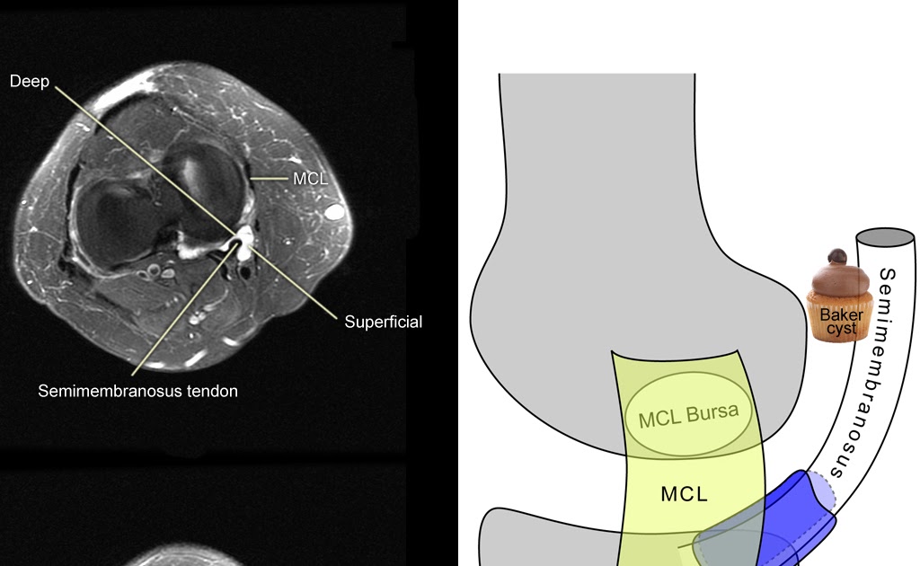 Roentgen Ray Reader: Semimembranosus-Tibial Collateral Ligament Bursa