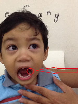 Hyzyd’s root canal treatment