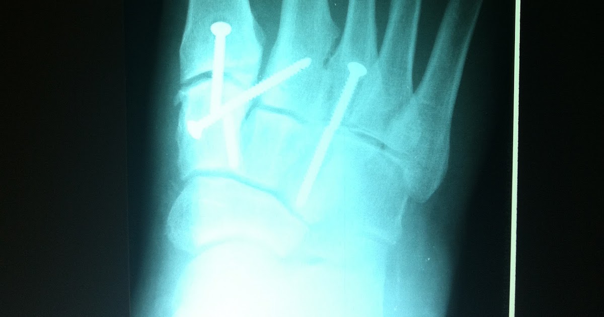 Podiatry Shoe Review Scared Straight Foot XRays that will scare you