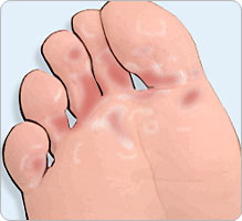 "Mycoses des pieds  Traitement" photo libre de droits sur la banque d'images 