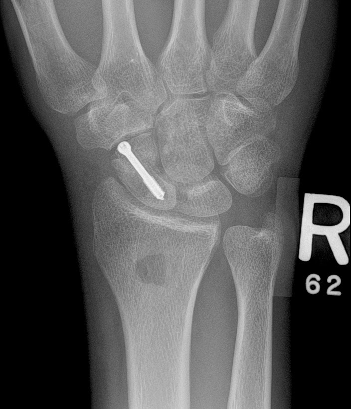 navicular fracture