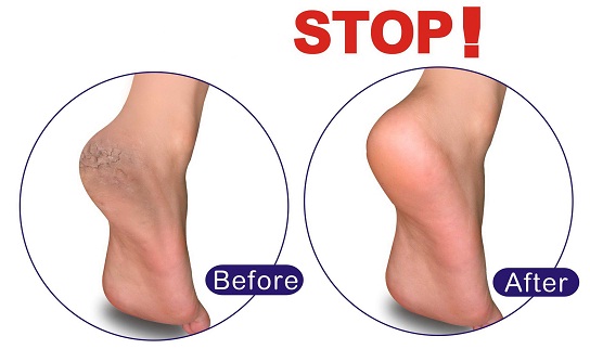 Foot Heel Cracks Home Remedies