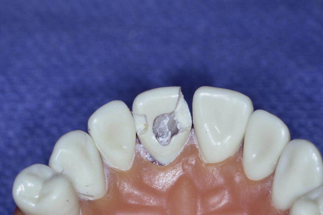 Dentistry Custom Cast Dowel Core