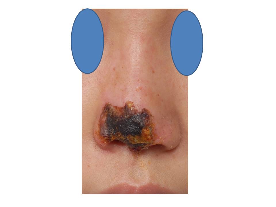 Shimmian Rhinoplasty Clinic (official blog in Korea) Nasal tip