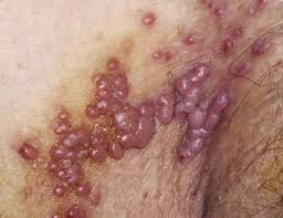 herpes obat herpes