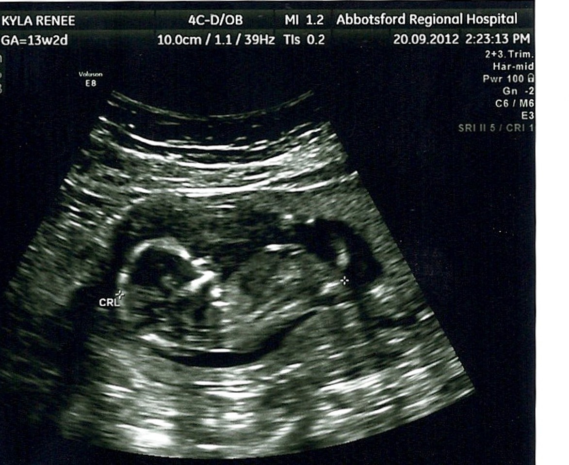 ultrasound dating accuracy 13 weeks