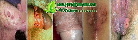 Image Gambar Kutil Kemaluan pada Anus