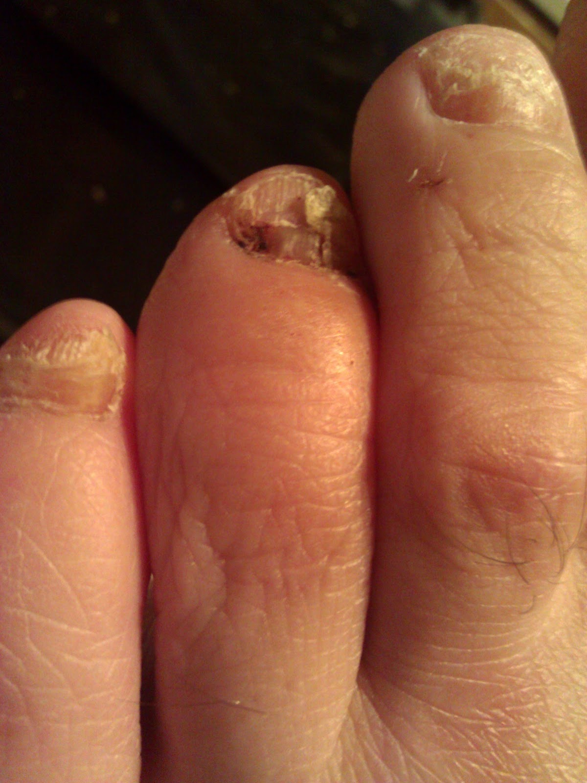 Disgusting Toenails