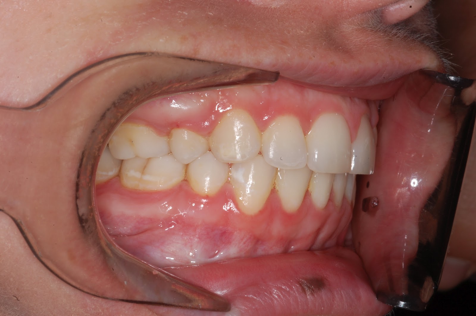 Truman Orthodontics Orthognathic Surgery