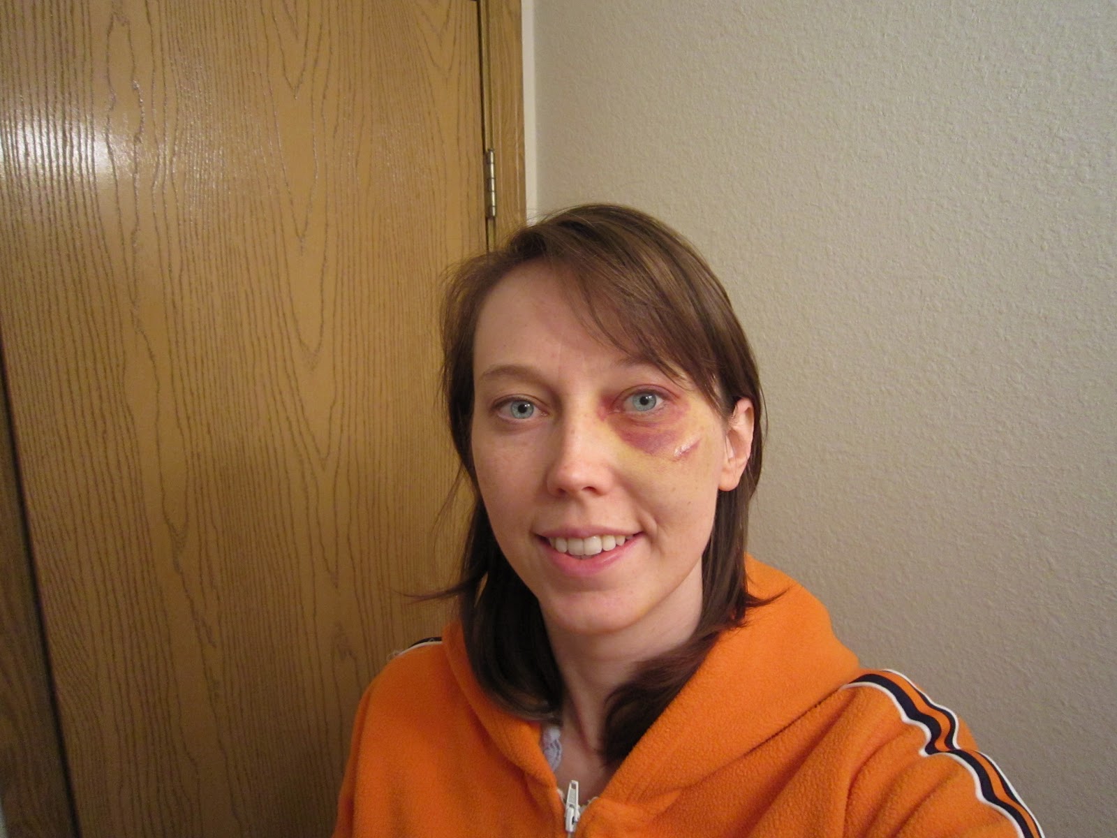 befuddled bug's blog of bewilderment My First Black Eye!!!