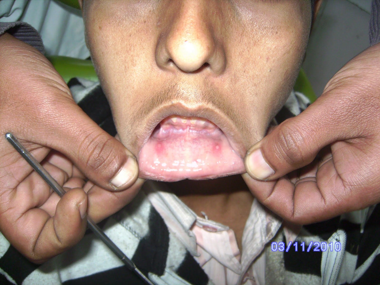 Labial Area