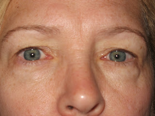 peel hetter eyes upper lower below surgery before