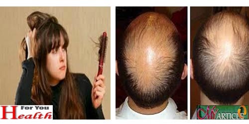 Causes of Hair Loss Location Different Women & Men Hair