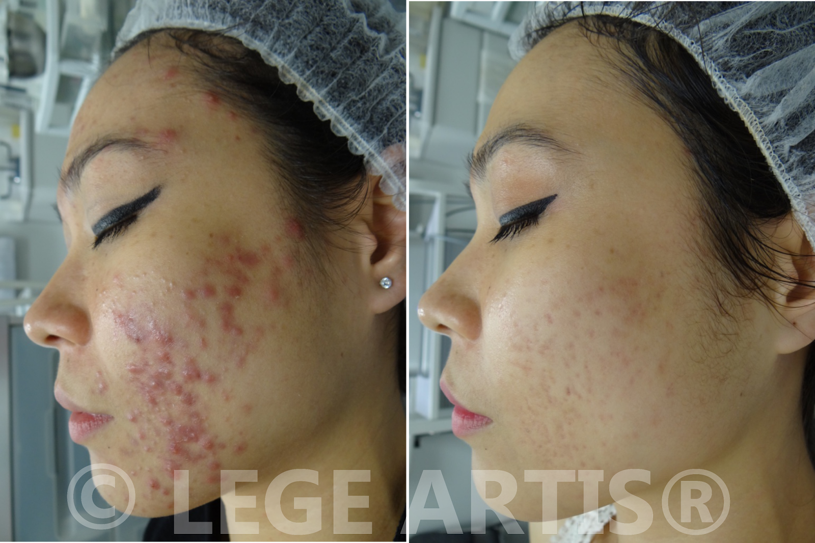 Lege Artis Blog New Success Story AcneProne Skin
