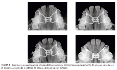 aparelho dentário, aparelho fixo, aparelho ortodôntico, diastema, disjuntor palatino, diário aparelho dentário, expansor fixo, expansor palatino, hirax, hyrax, mordida cruzada, ortodontia, aparelho dentário, aparelho fixo, aparelho ortodôntico, diastema, disjuntor palatino, diário aparelho dentário, expansor fixo, expansor palatino, hirax, hyrax, mordida cruzada, ortodontia,