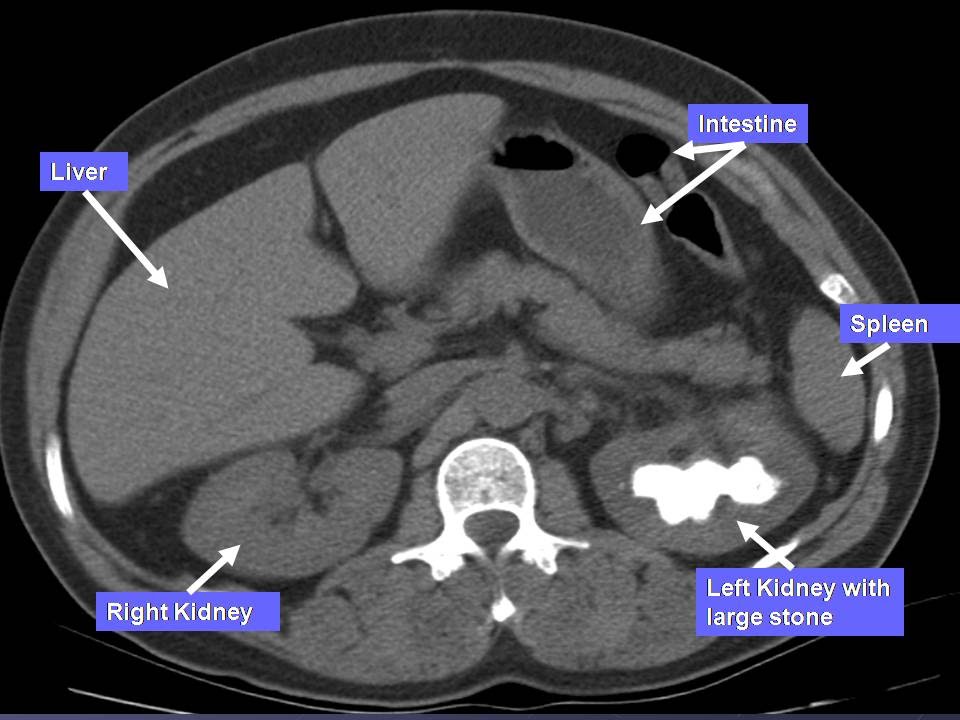 ct with contrast show kidney stones