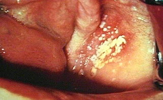 how to treat a vaginal yeast infection, symptoms of yeast infection, vaginal yeast infection, how to treat a yeast infection, how to treat yeast infection, cure yeast infection, what is a yeast infection, signs of a yeast infection, causes of yeast infections, home remedies for yeast infection, male yeast infection treatment, yeast infection in women, yeast infection relief, home cure for yeast infection, how to cure yeast infections, a vaginal yeast infection, yeast infection, yeast infection signs, yeast infections in women, yeast infection symptoms, yeast infections treatment, yeast infection women, causes yeast infection, home remedies for a yeast infection, treatment of yeast infection, yeast infection treatment for men, symptoms for yeast infection, treating a yeast infection, yeast infection home remedy, yeast infections in men, cause of yeast infection, yeast infection home treatment, natural yeast infection cures, cure yeast infections, yeast infections home remedies, male yeast infection cure, women yeast infection, treatment for yeast infections, home remedies yeast infection, what is a vaginal yeast infection, yeast infection treatment at home
