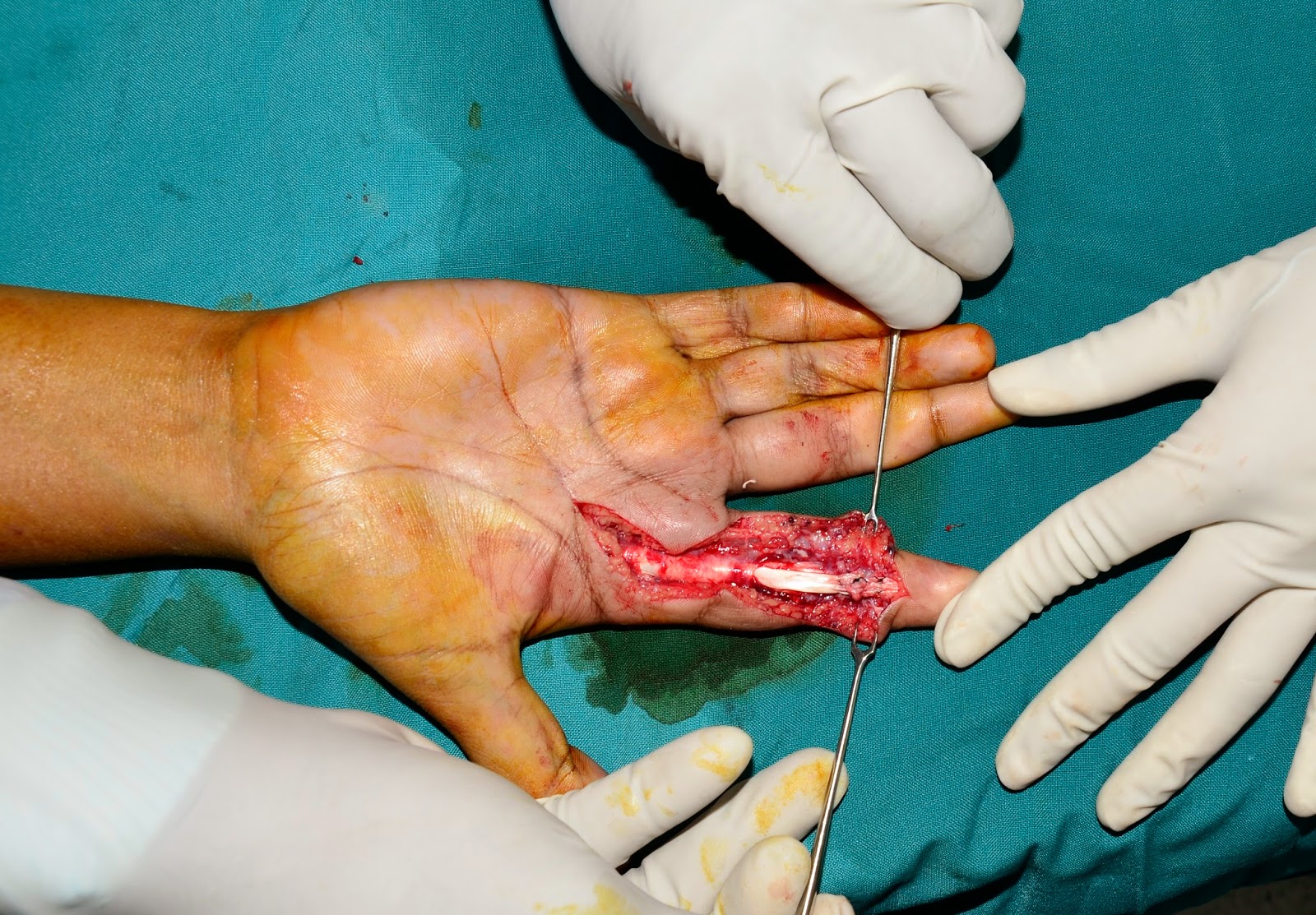 TWO MONTH OLD FLEXOR TENDON INJURY - RIGHT INDEX FINGER FDP DIVISION