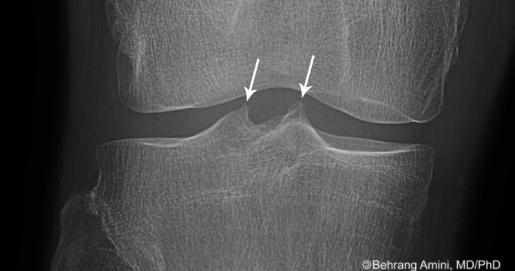 Roentgen Ray Reader Intercondylar Spine Spiking and