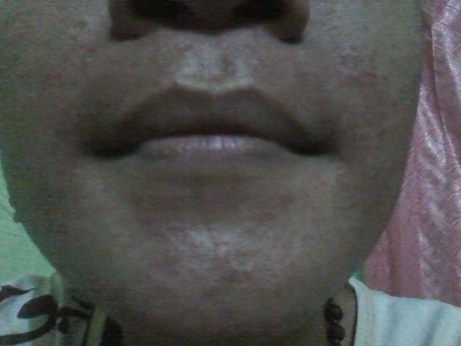 Ineng Dermatitis Akibat Krim Naava Green