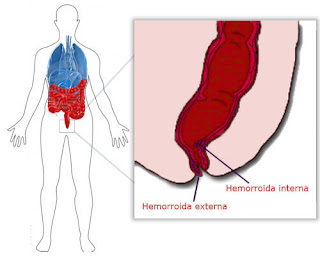 Hemorroidas