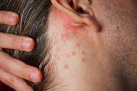 Comme traiter le psoriasis avec aloem