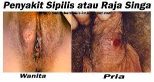 Penyakit Raja Singa Penyakit Raja Singa