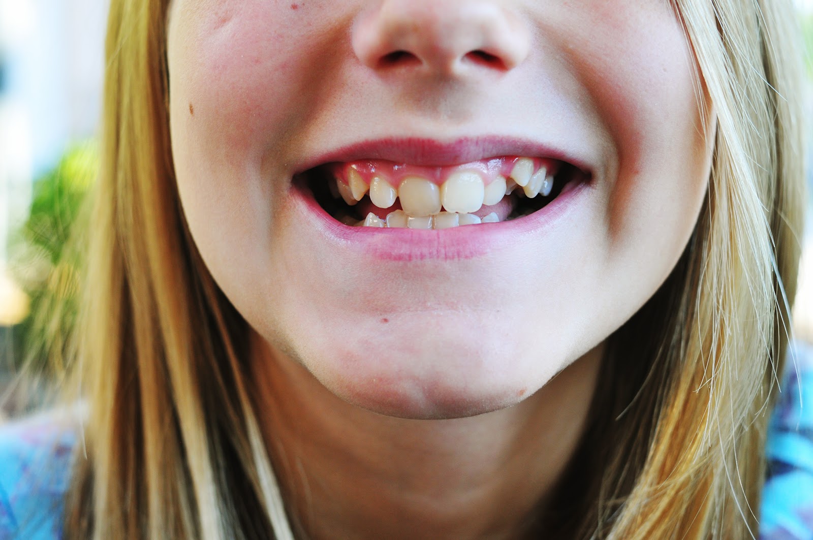 CHEEKY GIRL.....Photography & Life Braces Make Feel Old