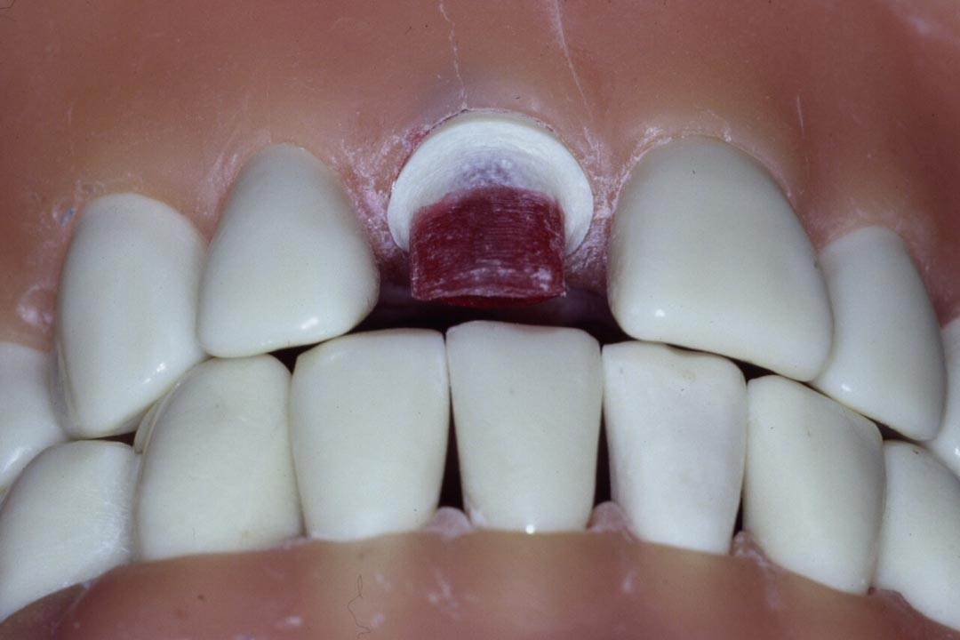 Dentistry Custom Cast Dowel Core