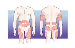ZONAS DE PUNCIÓN DE INSULINA