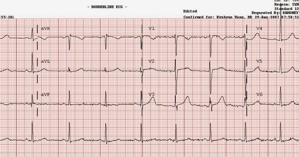 Dr. Smith's ECG Blog: Young man with syncope while riding a bike