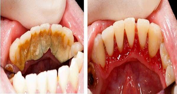 Be Your Own Dentist! Here are Tricks to Remove Tartar Buildup at Home tartar