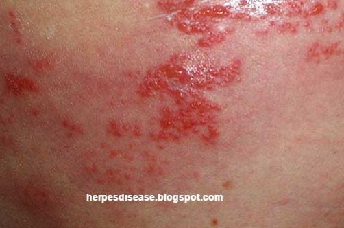 dating with type 1 genital herpes dating with type 1 genital herpes