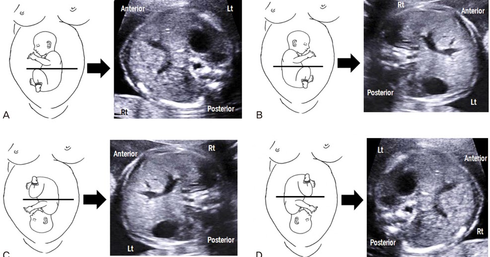 Bushra's Ultrasound Blog Abdominal Circumference with different fetal lies